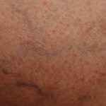 Vene e capillari visibili sulle gambe: quando il laser vascolare è indicato?